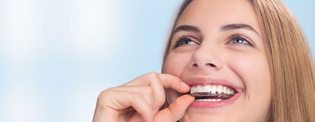 Removable Braces for Adults